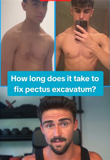 Transforming Pectus Excavatum Through Exercise