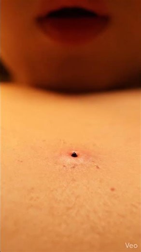 4K ASMR ♡ Lower Back Blackhead – Fingers Squeeze