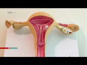 Hormonspiralen und ihre Nebenwirkungen