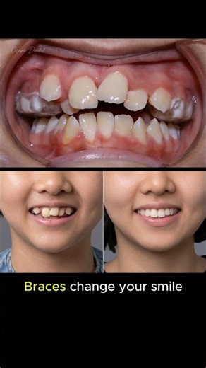 Braces fix crowded teeth. Change your smile #braces #braces #orthodontist #smilemakeover