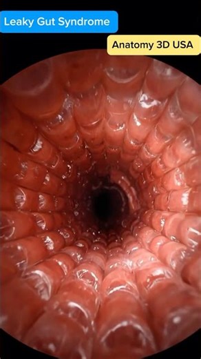 Leaky Gut Syndrome | Hyper Realistic Endoscopy Animation | Anatomy 3d USA
