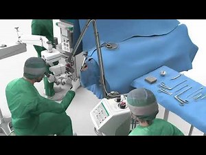 marLase Pro® | Cordectomy