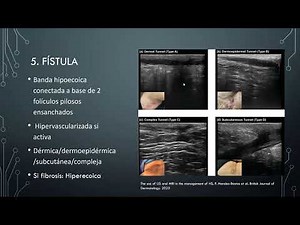 Ecografía en hidradenitis