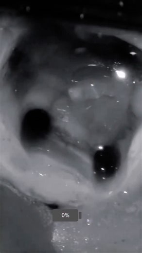 EASYINSMILE-DENTAL on Instagram: "✨ The Power of Photodynamic Therapy in Dentistry! ✨ Looking for maximum antimicrobial power with minimal tissue damage? The answer is PDT! 🔬 Effective even against resistant bacteria like Enterococcus faecalis 🌟 A new era in root canal disinfection 💡 Light + photosensitizer = microbial annihilation Go beyond traditional irrigation. Discover cleaner, safer, and smarter endodontics with photodynamic therapy. #PowerOfPDT #PhotodynamicTherapy #EndoInnovation #Roo