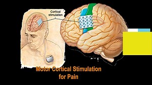 115K views · 2.4K reactions | We explained here how our equipment in the hospital helps to heal the patient without causing any harm. | Dr. Mohana Rao Patibandla - Neurosurgeon | Facebook