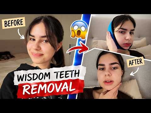 Getting ALL My Wisdom Teeth Removed 😱 (recovery vlog)