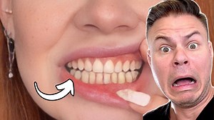 Dentist Reveals Why Brock Lesnar's Teeth Look Like THIS! 😮🦷 #teeth #grinding #dentist | TheBentistofficial