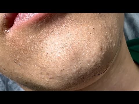 Blackhead extraction (chin):Relax with bye pimple
