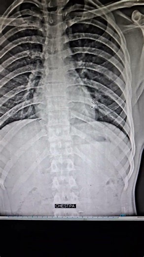 Chest X Ray #anatomy #doctor