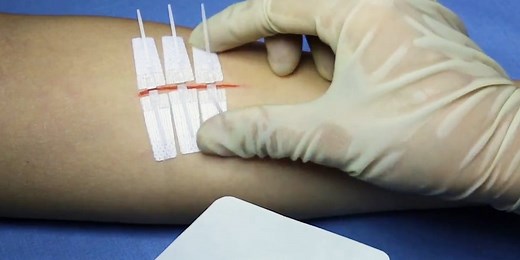 DermaClip is a needle-less alternative to stitches
