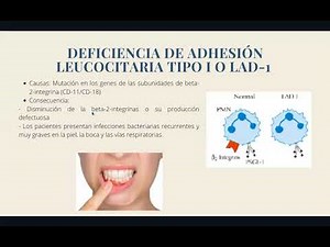 Deficiencia de adhesión leucocitaria tipo I / Karen Chica