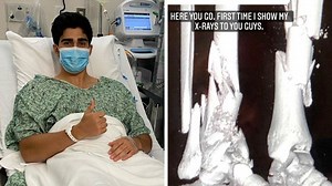 Star shares horrifying broken leg X-ray