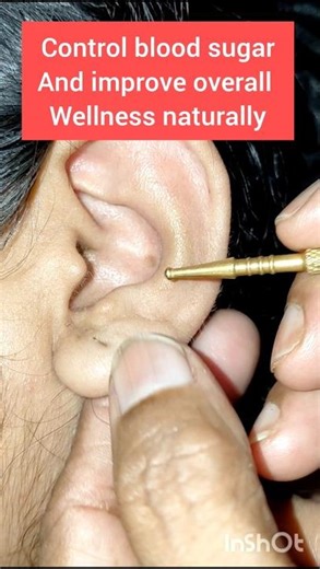 #diabetes #diabetesawareness #bloodsugarsupport #ytshorts #acupressure #auriculotherapy #shorts #fyp