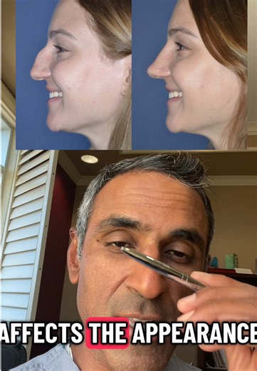 Dr NARASIMHAN explains the hump of the nasal bridge and how this is addressed surgically! Also the anatomy how to remove this during rhinoplasty #rhinoplasty #rinoplastia #nosejob
