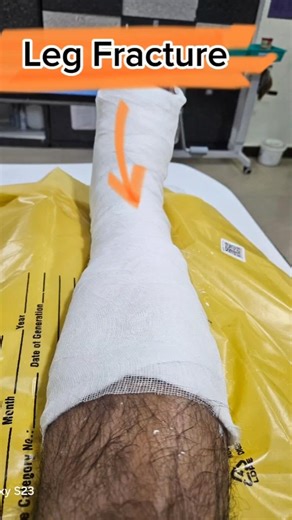 Leg Fracture But Still Training- Stay Disciplined stay Unbreakable #30daychallenge #motivation