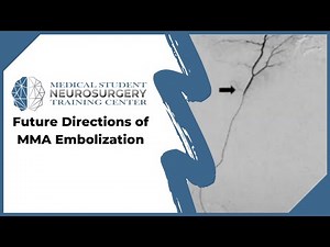 Future Directions of MMA Embolization