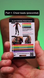 Demonstration of 4 electrode positions Part 1: Precordial leads Other demonstrations will include 👉 Right sided 🔙 Posterior 🫀 Dextrocardia 💾 Save for future reference 🤕 Master trauma in 30 days. Comment “TRAUMA” to get FREE access 🤜 Save it. Share it. Like it. | The Medical Lounge