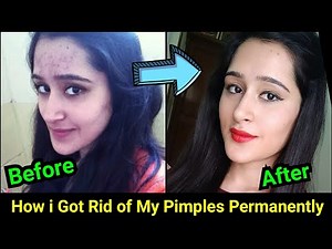 How to Remove Pimples, Acne, Pimple Marks completely | ThatGlamGirl