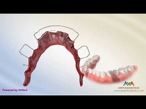 Orthodontic Retainer - Finger Spring