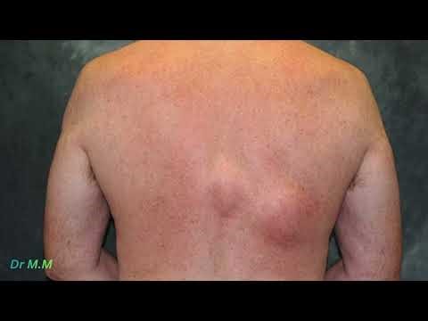 Lipoma Explained: Causes, Diagnosis & Treatment | Dermatology Review