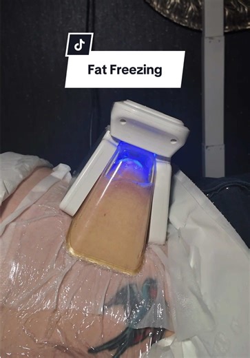 “Where did all your fat go? 👀” Fat freezing works by targeting stubborn fat cells and cooling them to a temperature where they crystallise and break down. Over the following weeks, your body naturally processes and removes these damaged fat cells through the lymphatic system. That means the fat doesn’t move somewhere else… it’s gradually eliminated. No needles. No surgery. No downtime. Just a gradual reduction in stubborn fat areas that diet and exercise often can’t shift. DM us “FREEZE” to lea