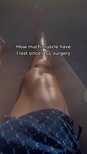 #stitch with @Idris #sMuscle Atrophy After Surgery #m#musclea#atrophyr#rehabP#PTp#physicaltherapyk#kneesurgeryA#ACLr#resurgencept