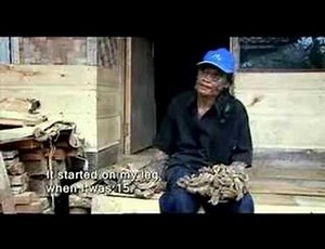 Tree man 'who grew roots'