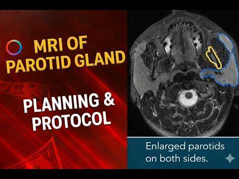 How to Perform MRI of Parotid Gland | Planning & Technique