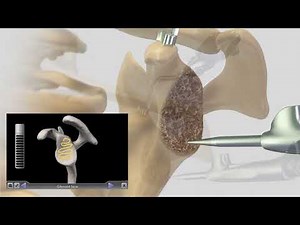 Jason L. Hurd, MD explains the use of ExactechGPS for Total Shoulder Replacements
