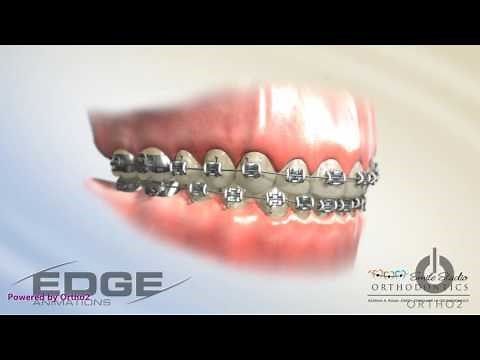 Decalcification - Due to poor hygiene with braces white spots