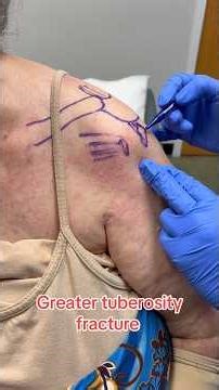 Greater tuberosity Fx and Rotator Cuff tears? #medstudent #physician #sportsmedicine #rotatorcuff