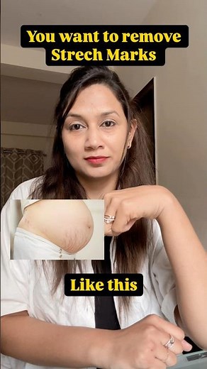 Clinically proven stretch mark treatment♥️