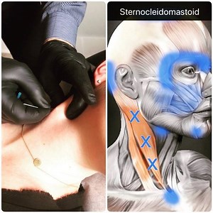 SCM (sternocleidomastoid muscle) and trigger point pain referral...