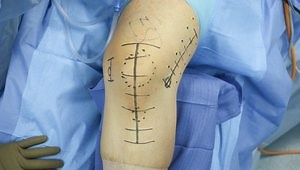 Combined DFO, TTO, and MPFL Reconstruction for Recurrent Patellar Instability