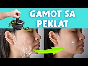 Ano mga natural na halamang gamot para maalis ang Peklat? Paano mawala o matanggal acne scars?
