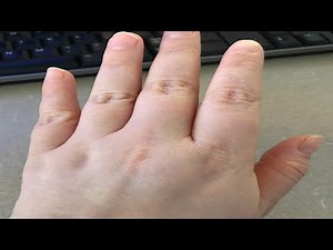 how to get rid of fat hands and fingers quickly