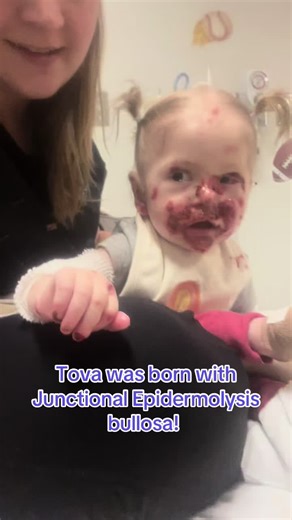 Tova's Journey with Junctional Epidermolysis Bullosa