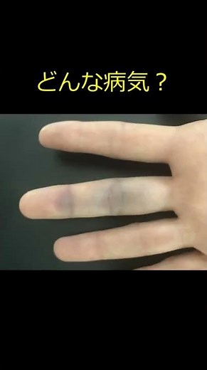 【アッヘンバッハ症候群】突然、指にアザができました ＃shorts