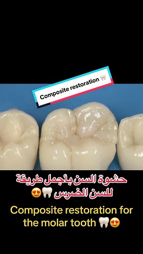 Composite Restoration for Molar Tooth: Best Technique Revealed