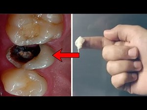 How to remove teeth cavity fast in 2 minutes - Get rid of teeth pain and cavity naturally at home