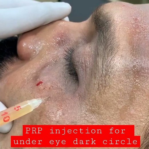 Under eye dark circle treatment using PRP injection