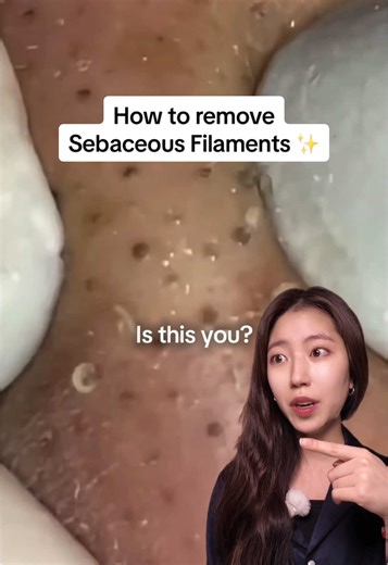 How to properly remove sebaceous filaments ✨ Products @ORIEN.OFFICIAL Zero Film Oil Cleanser, Zero Film Foam Cleanser @The Ordinary Granactive Retinoid 2% Emulsion #sebaceousfilament #pore #orien #zerofilm #koreanskincare