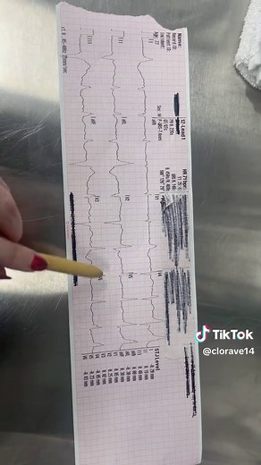 Understanding EKGs: A Step-by-Step Approach