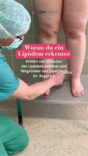 LipoCheck | Alles über Lipödem 💡 on Instagram: "👀Wie erkennt man ein Lipödem? Dr. Stefan Rapprich erklärt im Reel, woran man ein Lipödem erkennt und zeigt es an einer Patientin, die gerade für ihre Liposuktion vorbereitet wird. Er erzählt, dass sie ihren Beruf als Konditorin aufgrund des Lipödems irgendwann nicht mehr ausüben konnte. Ein Beispiel dafür, wie sehr das Lipödem das tägliche Leben und die berufliche Belastbarkeit beeinflussen kann. 📲 Wusstest du, dass du in der LipoCheck App deine