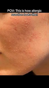 ➡️Pustules may form when your skin becomes inflamed as a result of an allergic reaction to food, environmental allergens, or poisonous insect bites. ✅Apply an over-the-counter treatment like calamine lotion, cortisone cream. Stay away from products that c | Dr. Farzan