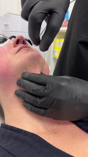 Non-Invasive EndoLift and InstaLase Procedures Explained