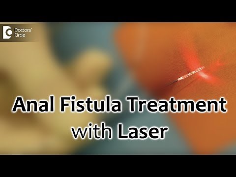 Anal Fistula Treatment with Laser. Painless and best recovery for fistula - Dr. Rajasekhar M R