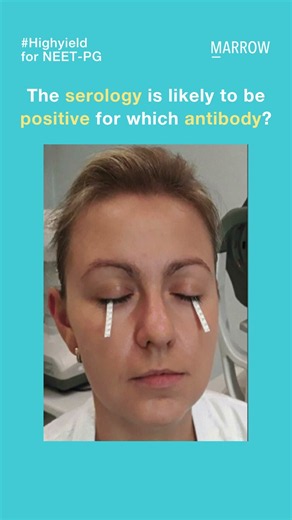 A patient presents with dry, itchy eyes and parotid swelling. The test shown is positive.