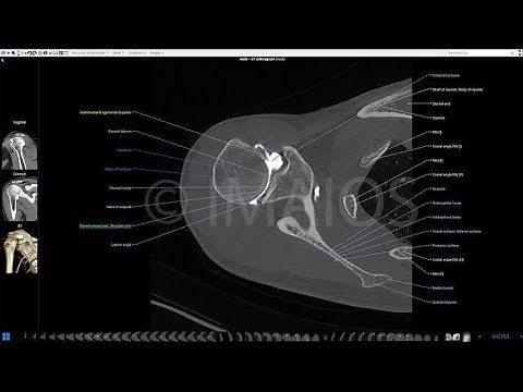 VRT & MPR of ct scan Rt shoulder on GE 16 slice