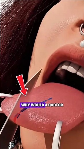 Tongue Split Surgery Explained!